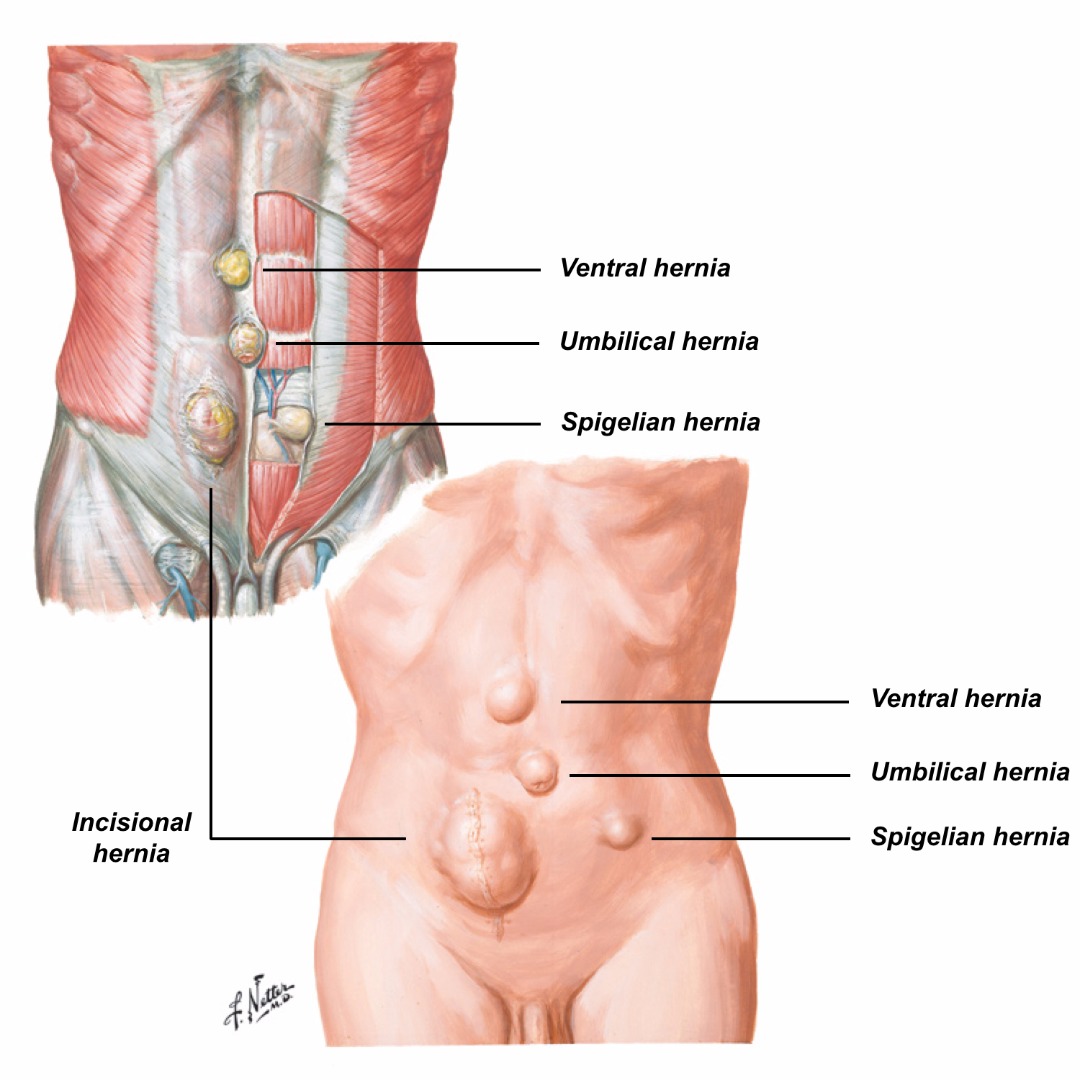 Mayo Clinic Q and A: Abdominal hernias do not go away on their own