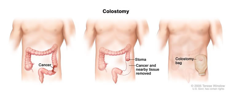 end colostomy
