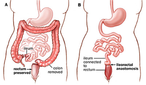 total abdominal colectomy