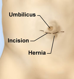 Umbilical Hernia Repair: What to Expect at Home