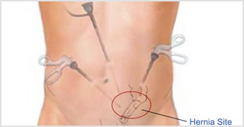 Laparoscopic Inguinal Hernia Repair: Benefits, Side Effects